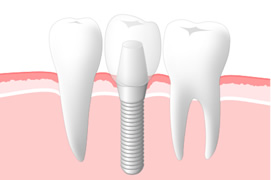 当院のインプラント治療