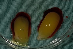 ②遠心分離後、CGF作成