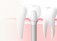 インプラント治療を考えられている方へ